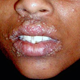Illustration for article titled Pengobatan Penyakit Herpes Zoster